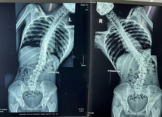 Preoperative full-spine X-ray of a 16-year-old scoliosis patient in Dhaka, Bangladesh-czmeditech Предоперационная рентгенограмма всего позвоночника 16-летнего пациента со сколиозом в Дакке, Бангладеш-czmeditech