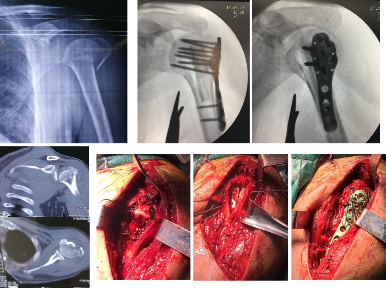 Перелом проксимального отдела плечевой кости