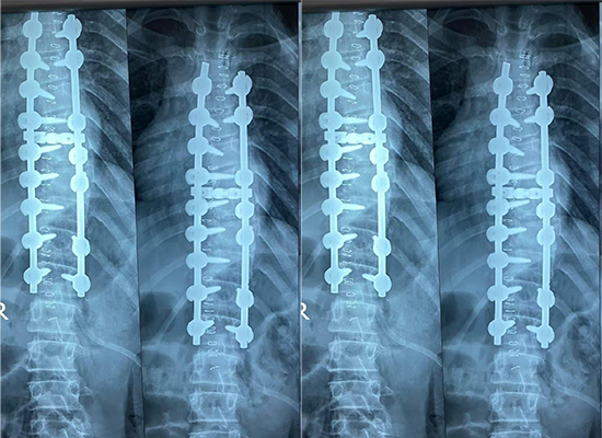 postoperative spinal x-ray showing corrected alignment after scoliosis surgery with pedicle screws-czmeditech послеоперационная рентгенограмма позвоночника, показывающая исправленное положение после операции по сколиозу с помощью транспедикулярных винтов — czmeditech