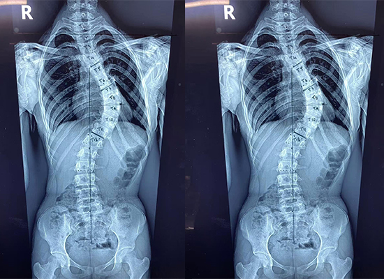 preoperative spinal x-ray showing scoliosis deformity in adolescent patient from bangladesh-czmeditech Предоперационная рентгенограмма позвоночника, показывающая сколиозную деформацию у пациента-подростка из Бангладеш-czmeditech