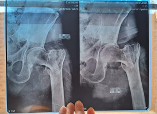 Preoperative X-ray showing left intertrochanteric fracture in elderly patient in Peru-czmeditech Предоперационная рентгенограмма, показывающая межвертельный перелом слева у пожилого пациента в Перу-czmeditech.