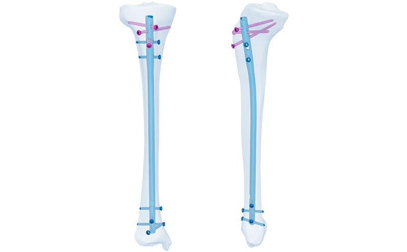 专家级胫骨钉_副本_副本