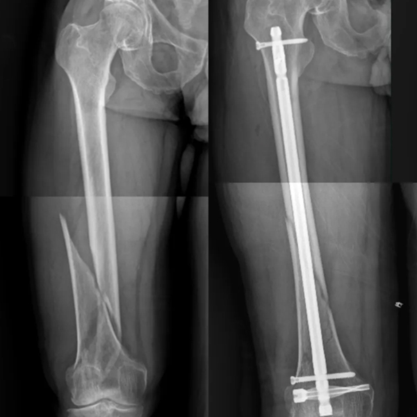 DFN дистальный интрамедуллярный гвоздь DFN