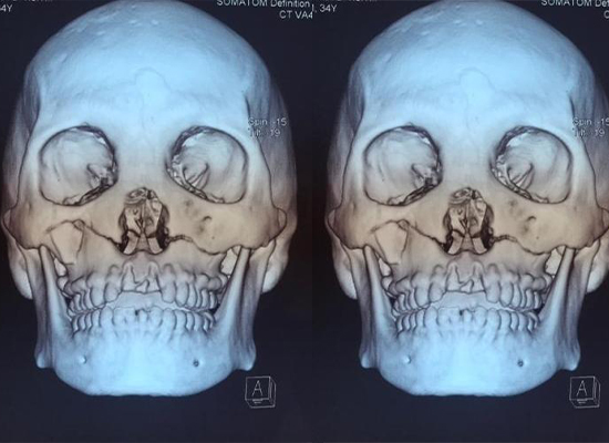 preoperative-imaging-lefort-fracture-ghana-czmeditech предоперационная визуализация-перелом Лефорта-Гана-czmeditech