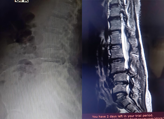 lumbar spine stenosis preoperative X-ray стеноз поясничного отдела позвоночника, предоперационная рентгенография
