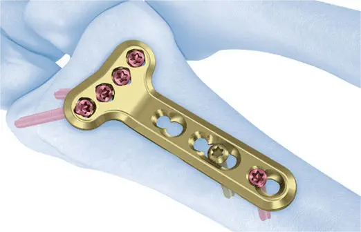 Дистальная стопорная пластина ладонной лучевой кости