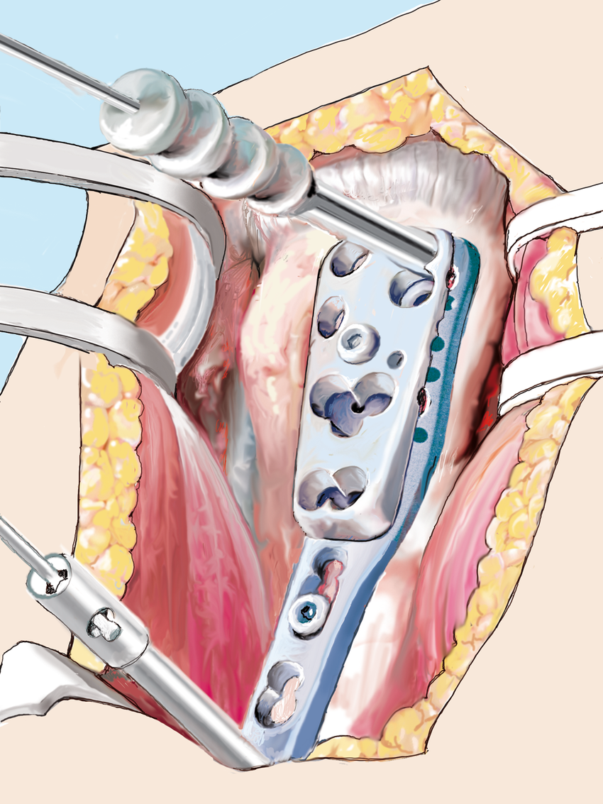 Проксимальная фиксирующая пластина плечевой кости