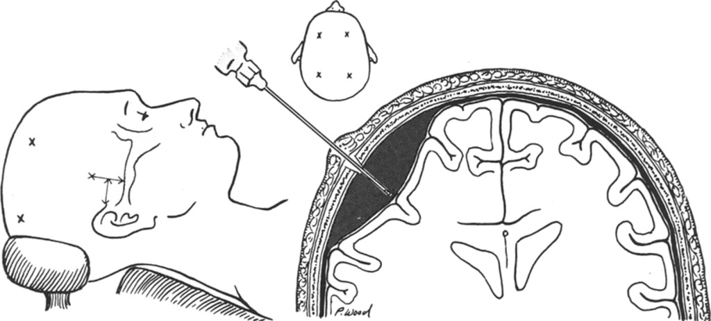 Саморезная дрель для краниотомии
