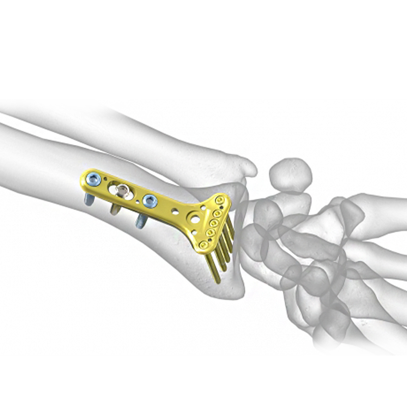 Фиксирующая пластина VA дистального отдела лучевой кости