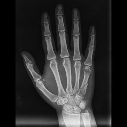 Пястные стопорные пластины