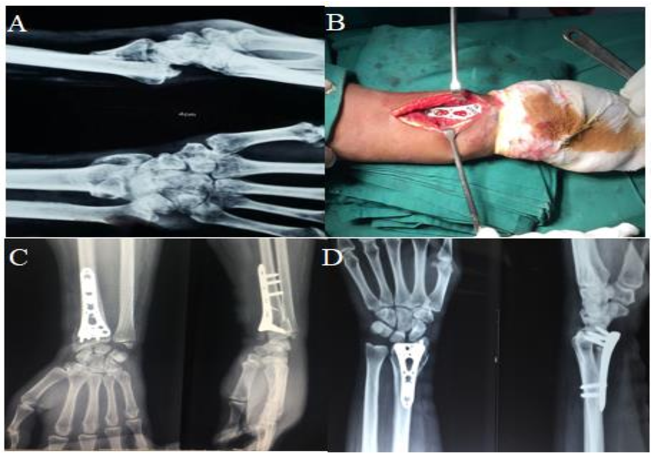 хирургия стопорной пластины