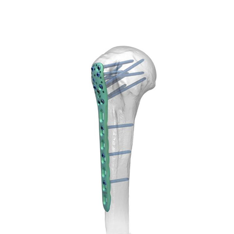 Проксимальная фиксирующая пластина плечевой кости