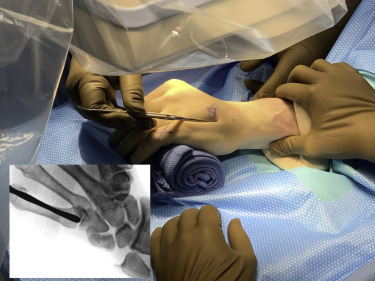 Хирургическая процедура стопорной пластины пястной кости пальца