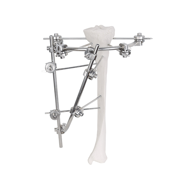 Внешний фиксатор плато большеберцовой кости