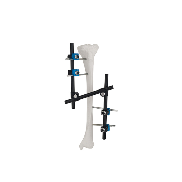 Z -тип (режим улучшения) внешний фиксатор