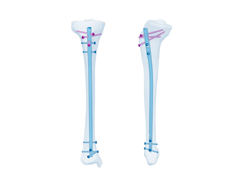 Большеберцовый интрамедуллярный гвоздь Expert: улучшение ортопедических операций