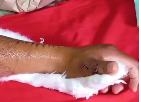 послеоперационное восстановление-движение-большого пальца-спорт-медицина-czmeditech 