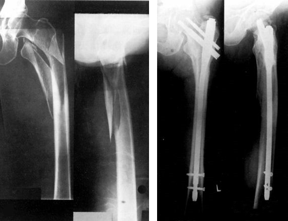 Перелом проксимального отдела бедренной кости - межвертельный перелом