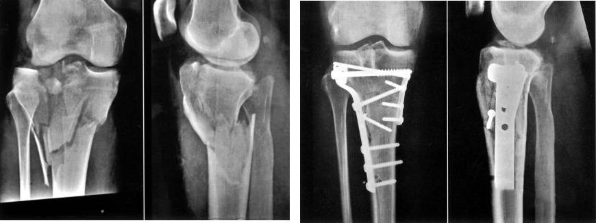 Проксимальный перелом большеберцовой кости