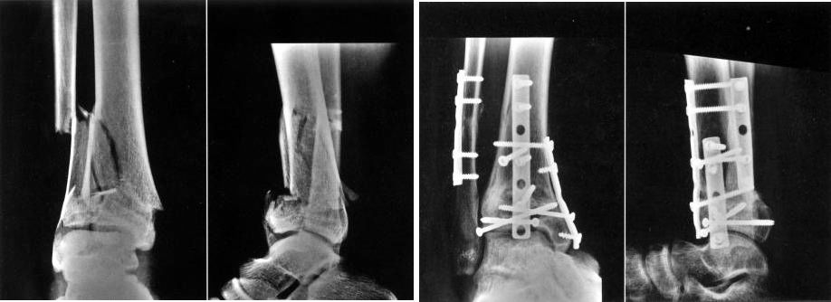 Поддержка костной пластины