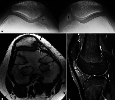 Лечение нестабильности пателлофеморального сустава у детей