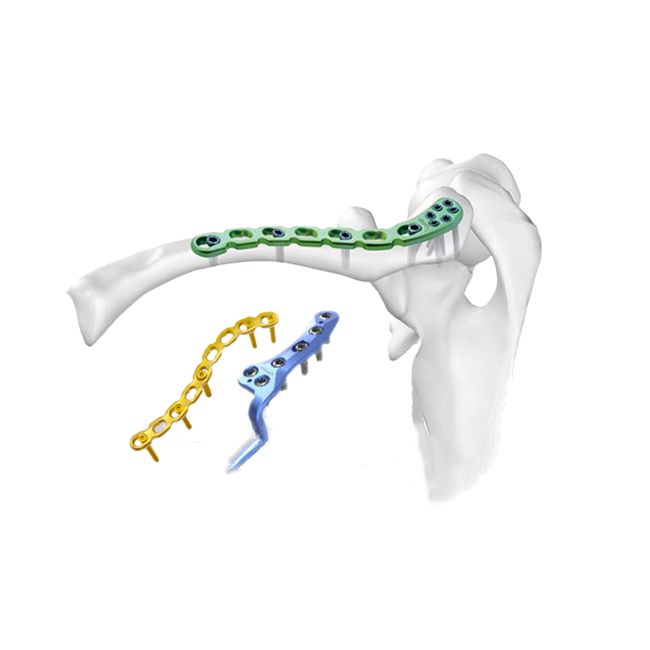 Фиксирующая пластина ключицы: повышение стабильности и заживления