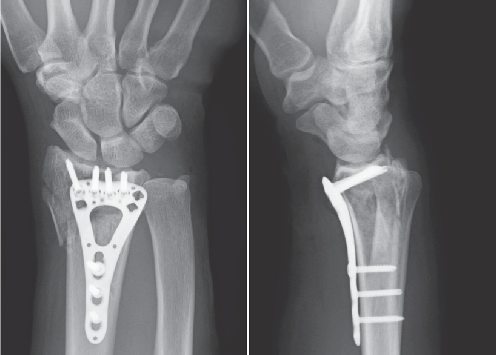 Знаете ли вы историю стопорной пластины?