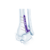 VA Distal Bipia Bocking L-Plate