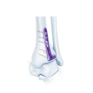 VA Distal Bipia Bocking L-Plate