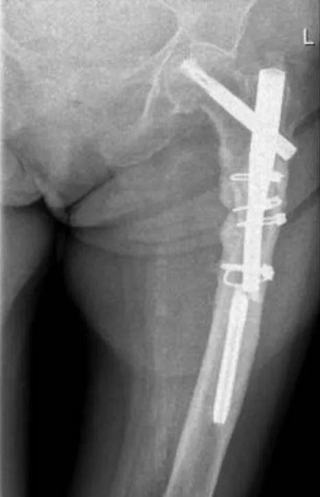 Интрамедуллярный разрыв ногтя