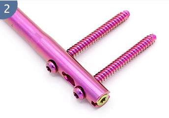 Эксперт R/AFN. Ретроградный /антеградический бедренный гвоздь (2)