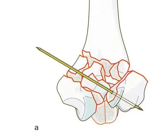 Реконструкция блока и головчатого мозга