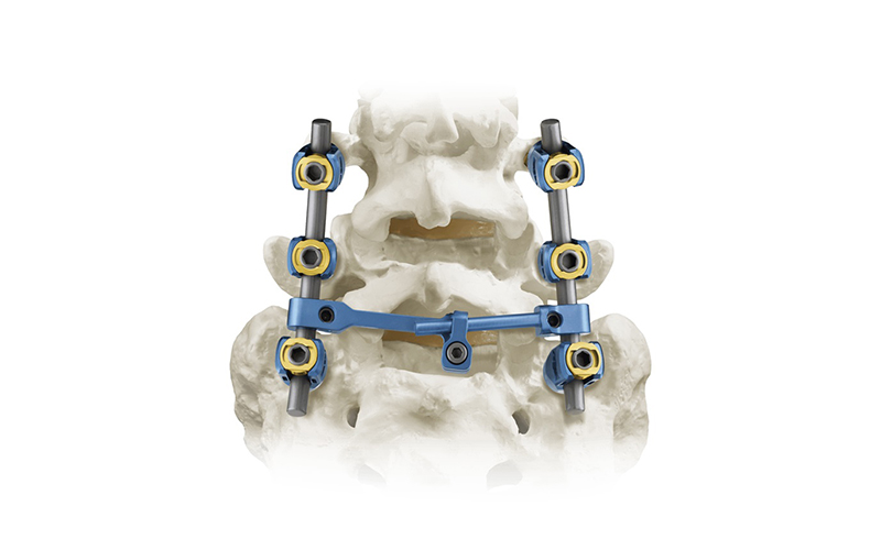 5.5-Спинно-педикулярная винтовая система