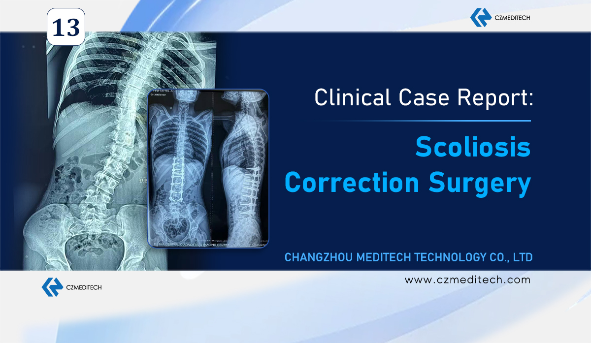 Операция по коррекции сколиоза в Бангладеш: система винтов на транспедикле диаметром 6,0 мм