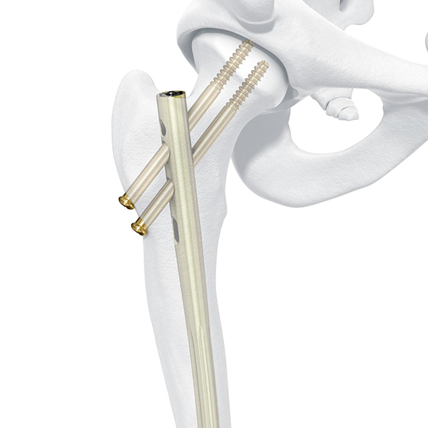 Бедренный гвоздь