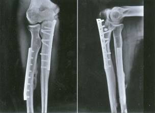 Двойной перелом предплечья