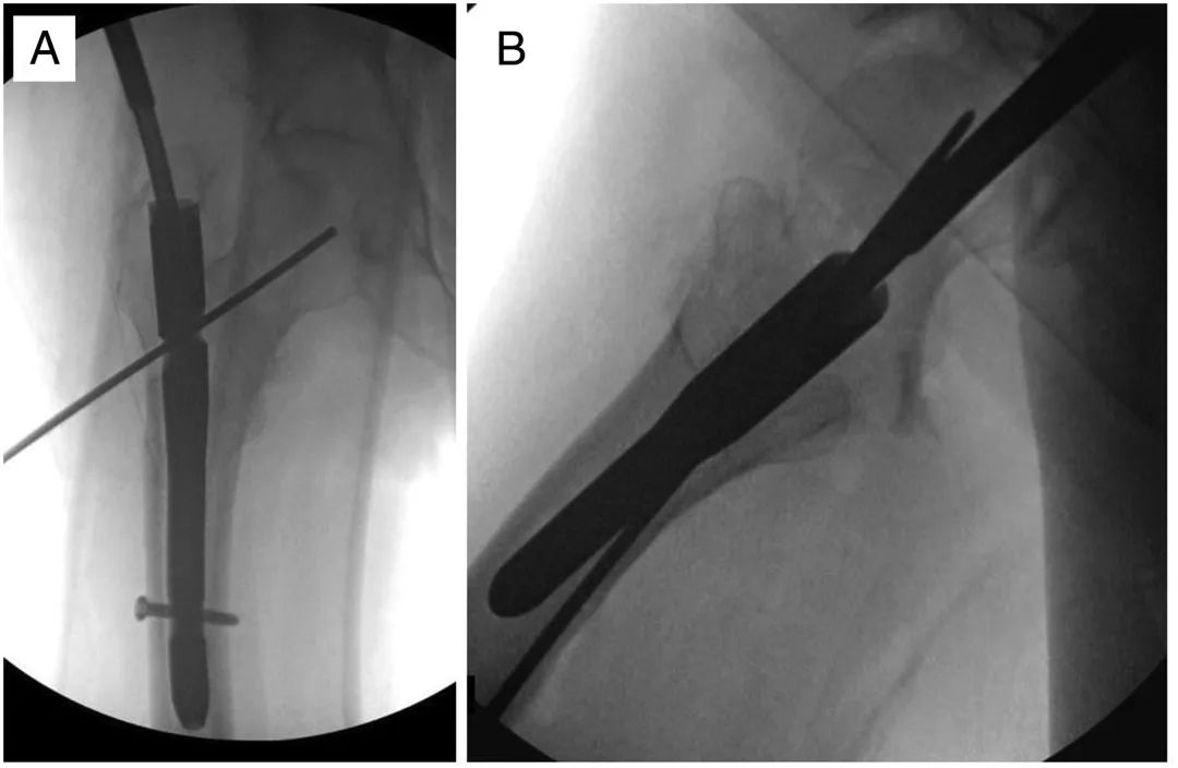 Интрамедуллярный гвоздь