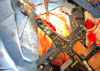 Плечевая-процедура-вставки гвоздя-czmeditech2