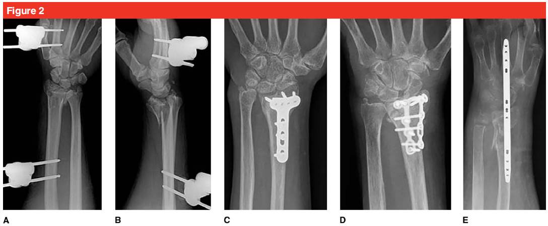 Фиксирующая пластина ладони