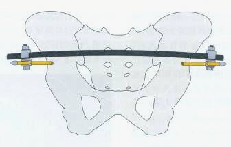 Перелом таза