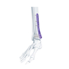 VA Distal Medial Bociate Plate