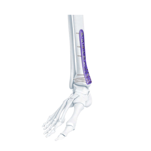 VA Distal Medial Bociate Plate
