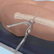 Проволочные щипцы для серкляжа