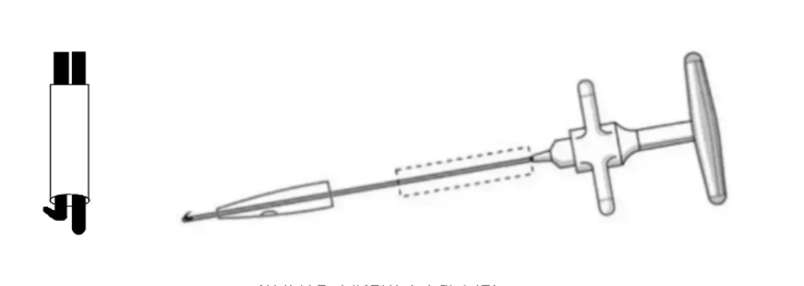 Удаление сломанного канюлированного интрамедуллярного гвоздя
