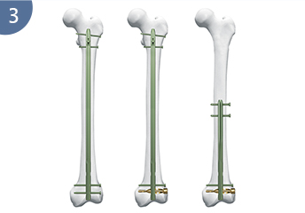 Эксперт R/AFN. Ретроградный /антеградический бедренный гвоздь