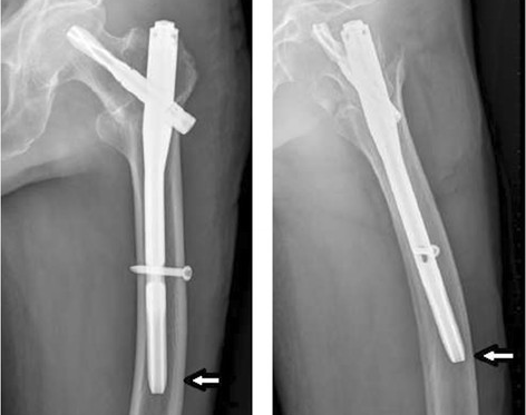 Рентген показывает-наконечник-PFNA-II-против-латеральной-стенки-у-пожилых-пациентов-с_副本
