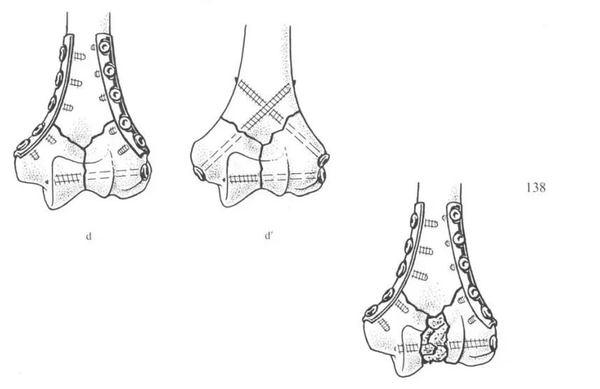 дистальный отдел плечевой кости