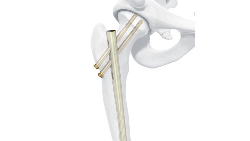 Что такое бедренный гвоздь?