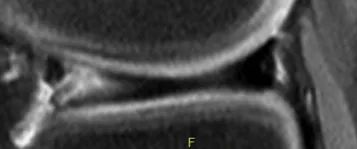 Дегенеративный вид мениска