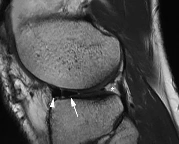 Гигантский угол полумесяца итамаэ